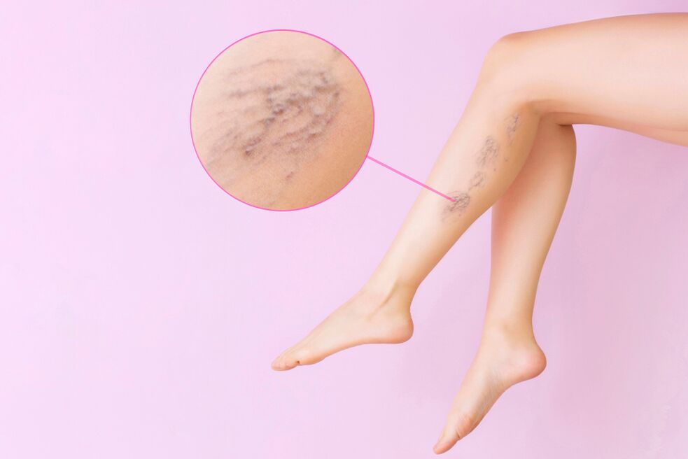 symptoms of varicose veins in legs