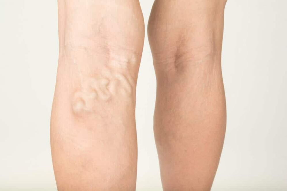 manifestation of varicose veins